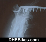 Click on the image for more info and a larger downhill mountain biking injury picture